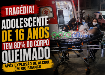 Adolescente de 16 anos tem 80% do corpo queimado após explosão de álcool em Rio Branco