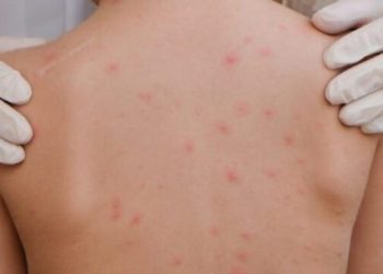 Casos confirmados de meningite caem 35% no Acre em 2026