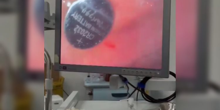 Médicos retiram bateria de lítio do estômago de criança de 1 ano e 9 meses no Acre Médicos retiram bateria de lítio do estômago de criança de 1 ano e 9 meses no Acre